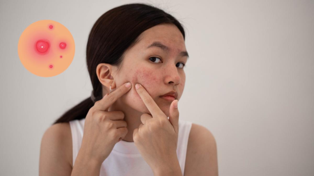 Acne के घरेलू उपाय – Neem, हल्दी, टी ट्री ऑयल से पिंपल्स दूर करें