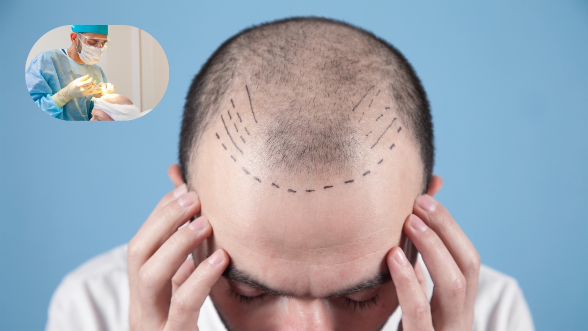 Hair Transplant कराना चाहते हैं? जानिए असली कीमत और सच्चाई